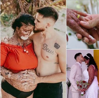 She was bullied by people who didn’t understand her condition – they called her rude names & said such as “monster” & ”zombie”. 😢💔 But her husband has the perfect response to haters – check comments 👇